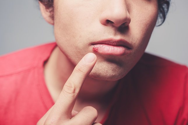 Lo normal es que la estomatitis herpética cause una serie de ampollas en la boca del niño 
