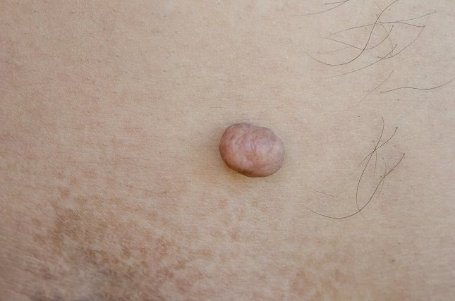 El virus se vuelve es menos vulnerable cuando la piel que lo cubre es seco