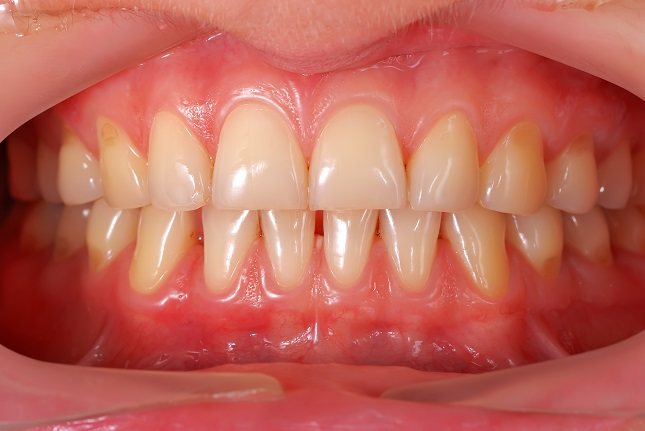Las encías inflamadas puede deberse a muchos motivos
