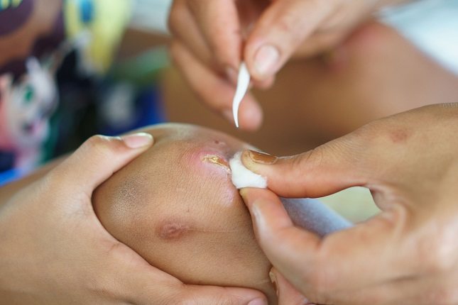 Hay varios tipos de cicatrices que van a depender del tipo de herida que sufra la persona