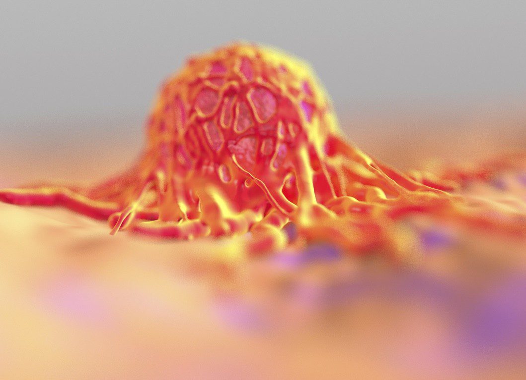 7 síntomas del cáncer de colon