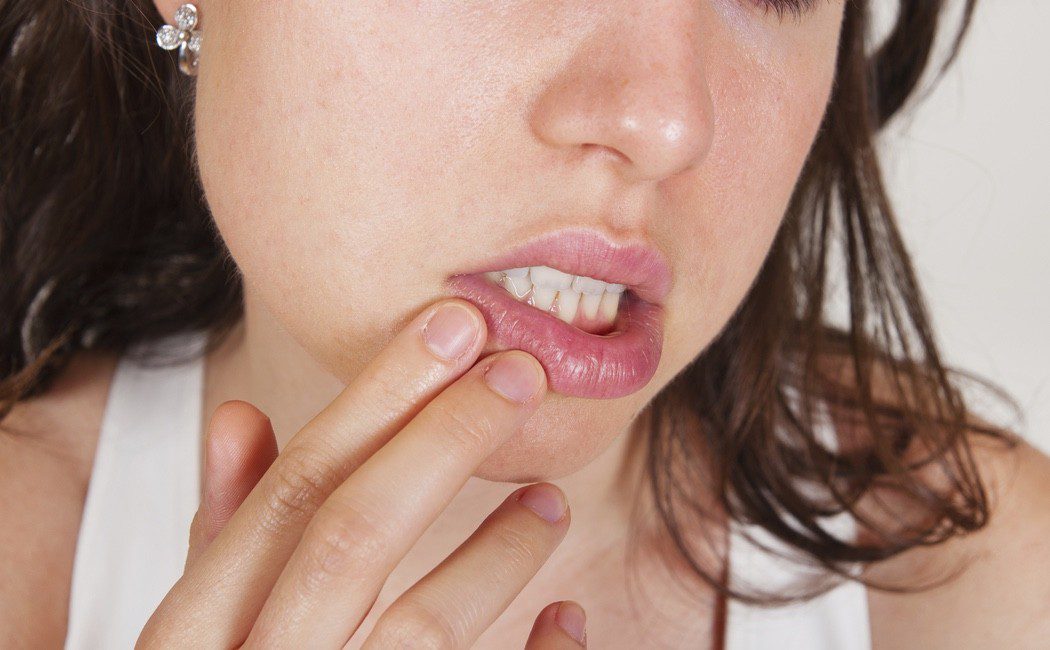 Herpes labial: Todo lo que debes saber