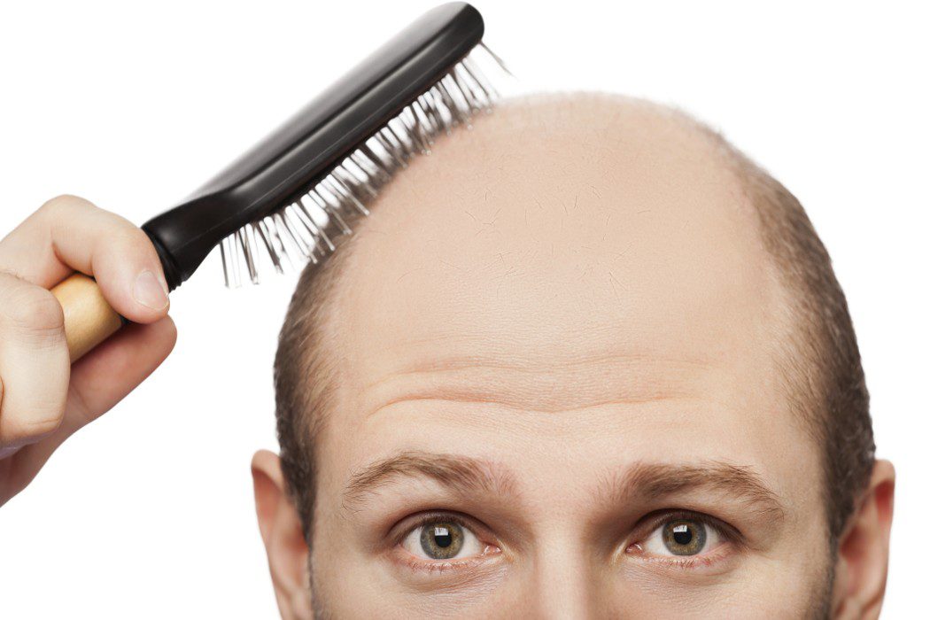 Minoxidil contra la alopecia, ¿es efectivo?