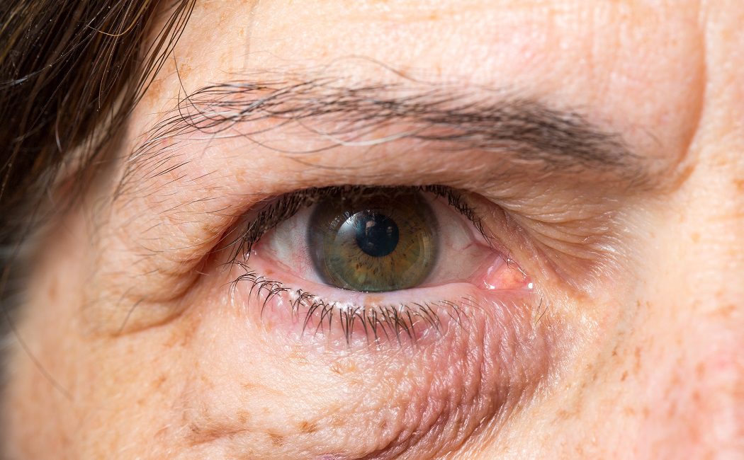 3 motivos por los que tienes los ojos hinchados
