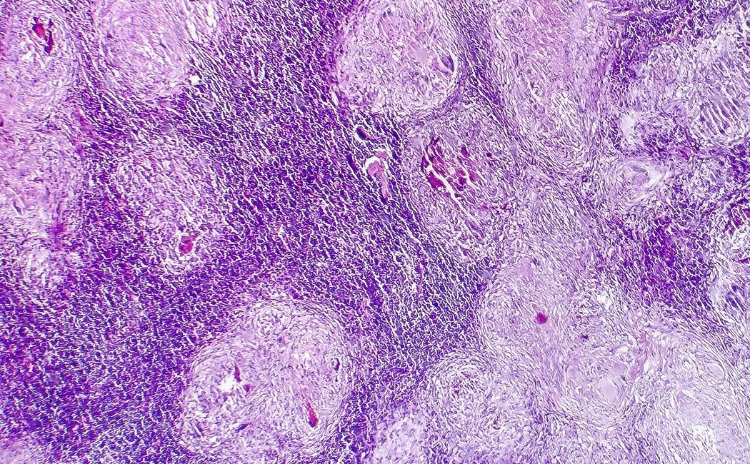 Necrosis avascular en la cadera