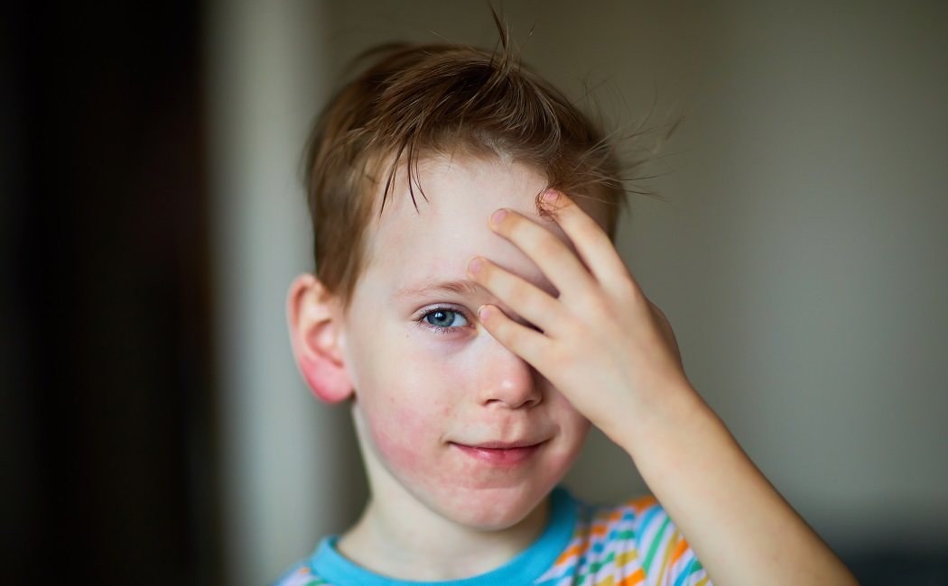 Qué es la dermatitis seborreica