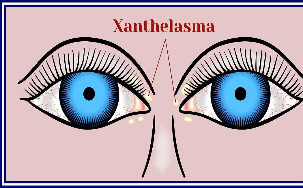 En qué consiste el xantelasma