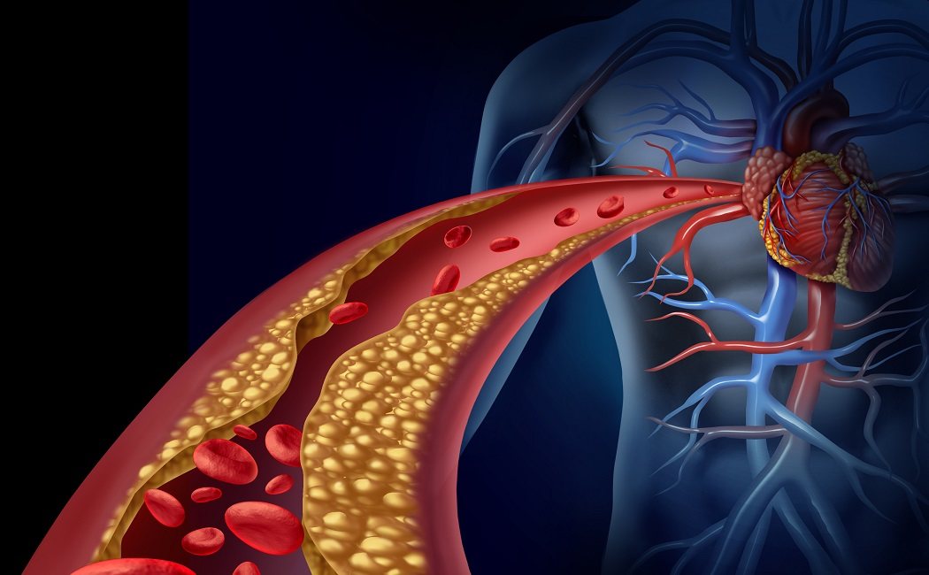 Fibrilación auricular; cuando el corazón baila a su ritmo