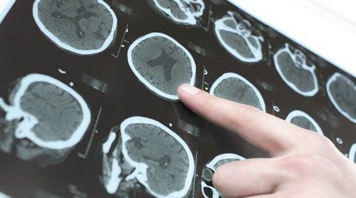 Qué es un hematoma intracraneal