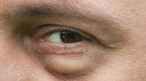 Por qué salen las bolsas debajo de los ojos