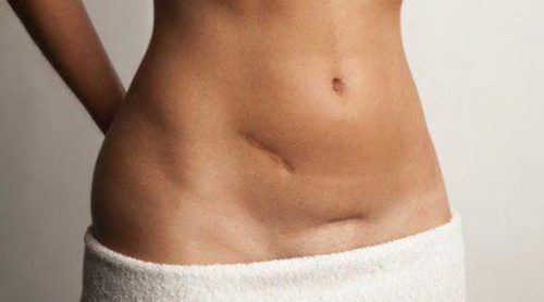 Hernia inguinal: Qué es y cómo prevenirla