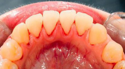 ¿Qué es la gingivitis?