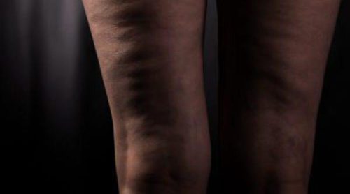 ¿Es posible eliminar la celulitis?