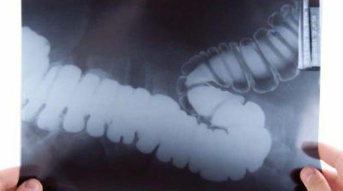 El cáncer de colon