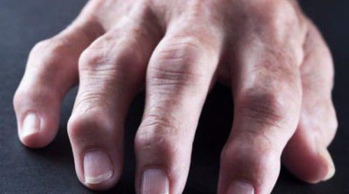¿Es lo mismo la artrosis que la artritis?