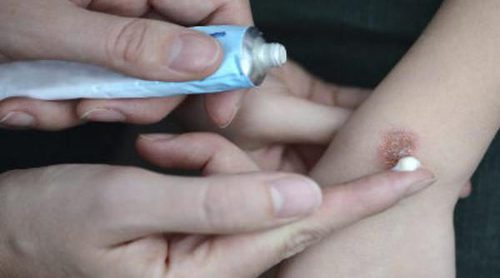 ¿Cómo tratar adecuadamente una quemadura en casa?