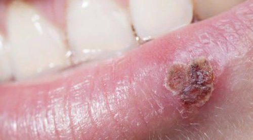 ¿Cómo podemos identificar el liquen plano?