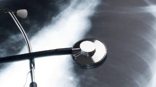 Causas y síntomas de la fibrosis pulmonar
