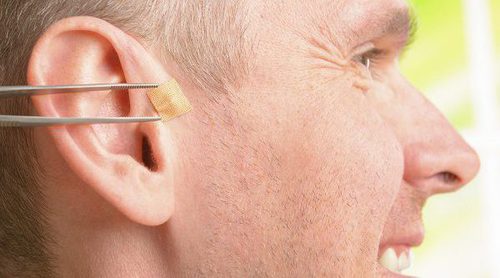 Qué es la auriculoterapia y para qué sirve