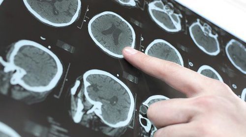 Qué es un derrame cerebral y por qué se produce