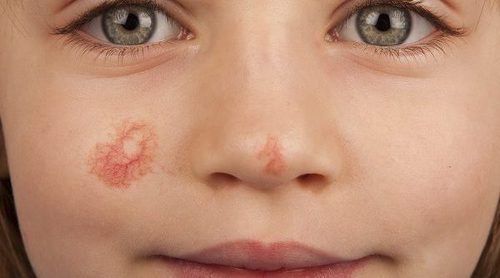 Cuál es el mejor tratamiento para un angioma