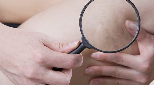 Embolias: todo lo que debes saber