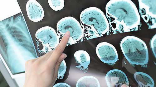 Cuáles son los tipos de Esclerosis Múltiple