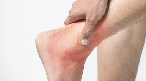 Cuál es el mejor tratamiento de un espolón calcáneo
