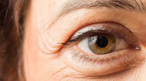 Qué son las bolsas en los ojos y por qué salen