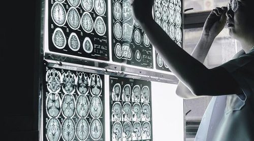 Cuáles son las causas de la epilepsia y factores de riesgo