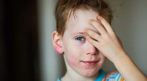 Cómo saber si tienes dermatitis atópica