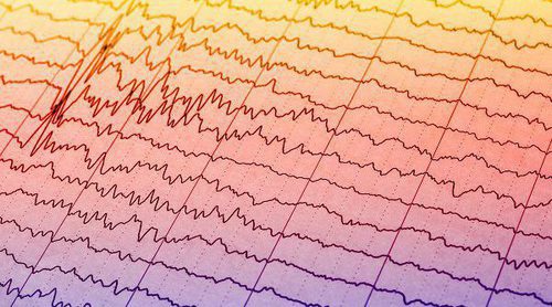 Cómo se debe actuar ante una crisis epiléptica