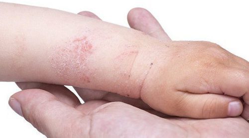 6 secretos para cuidar la piel atópica