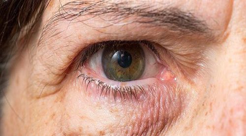 3 motivos por los que tienes los ojos hinchados