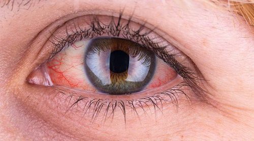 8 remedios caseros para la conjuntivitis