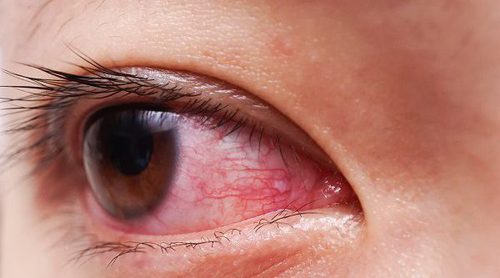 Conjuntivitis vírica: cómo tratarla