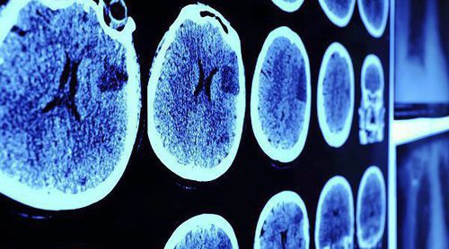 Cuáles son los síntomas del aneurisma cerebral