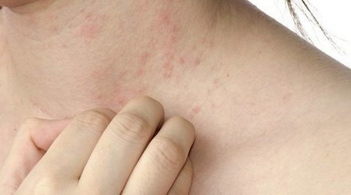 Qué es la dermatitis herpetiforme
