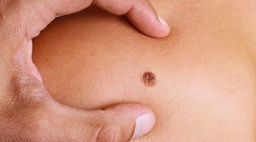 Tipos frecuentes de cáncer de piel