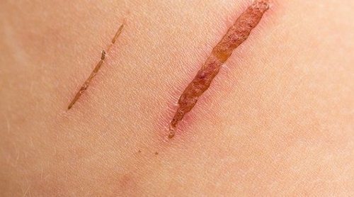Qué es y cómo tratar el seroma