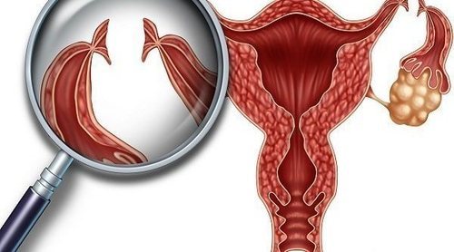 Tratamiento para las trompas de Falopio obstruidas