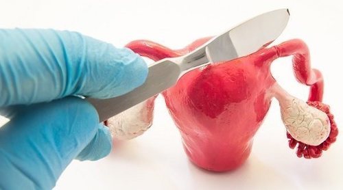 Trompas de Falopio obstruidas