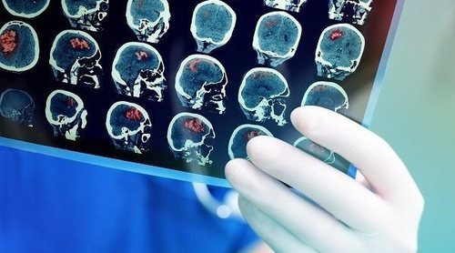 Qué es la isquemia cerebral