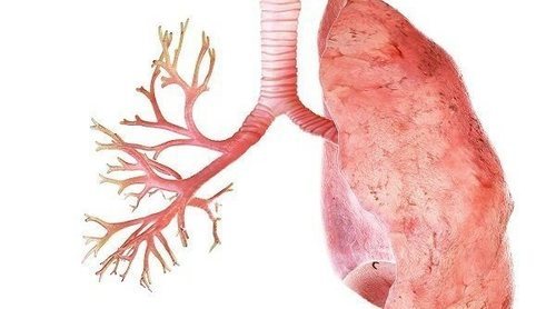 Problemas frecuentes en los bronquiolos