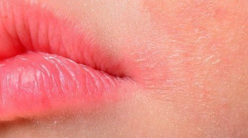 Remedios eficaces para la dermatitis seborreica
