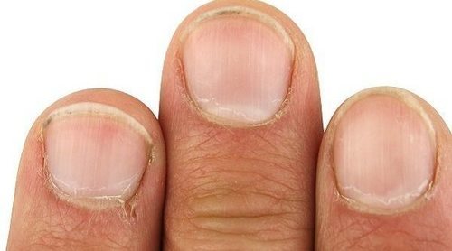 Por qué se ponen las uñas negras