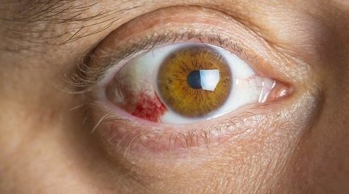 Síntomas y tratamiento de la queratitis