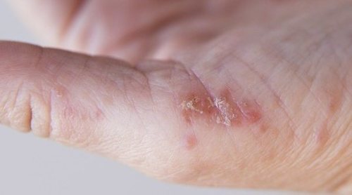 Psoriasis guttata