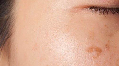 Qué es el melasma