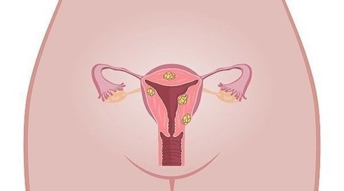 ¿Qué son los fibromas uterinos?